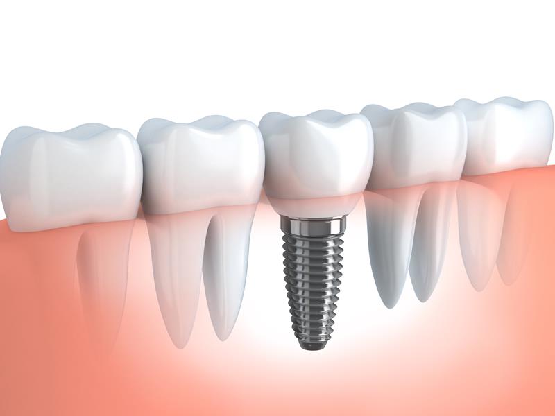 Dental Implants Bothell, WA