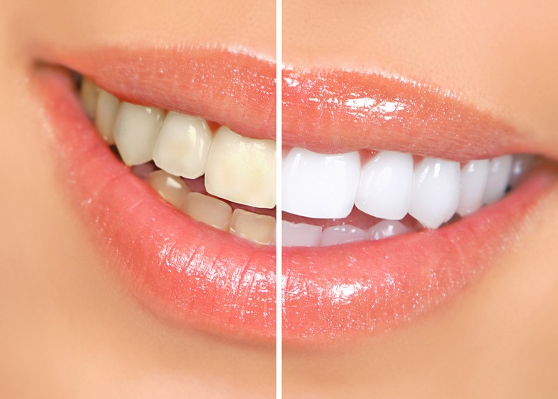Teeth Whitening Bothell, WA